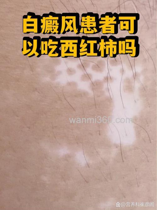听说有白癜风的人不能吃西红柿?为什么呢?那鱼能吃吗?